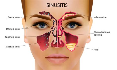 The Relationship Between Your Sinuses and Your Oral Health