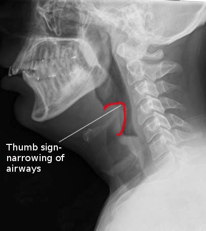 Thumb Sign Epiglottitis