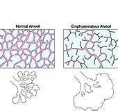 ~Bulbus emphysema~ :: ~sq emphysema definition~