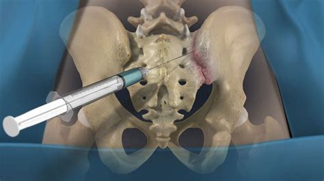 A sacroiliac joint (SIJ) block is an injection of local anesthetic and a steroid medication into ...