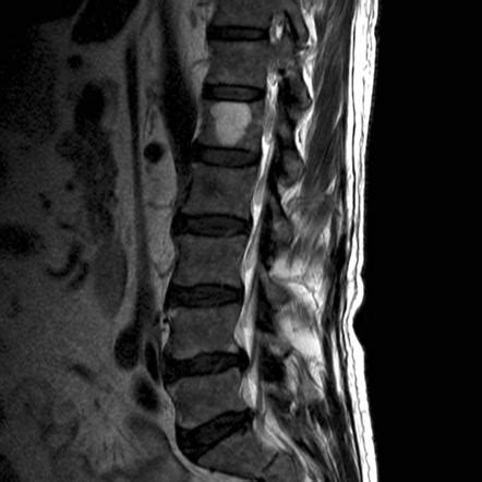 Vertebral haemangioma | Radiology Reference Article | Radiopaedia.org