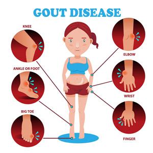 Refractory Gout - Signs, symptoms, treatment, diagnosis | National Kidney Foundation