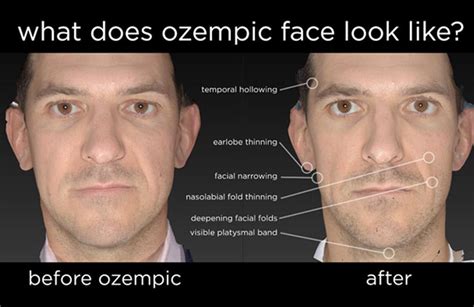 Ozempic for Weight Loss: What is Ozempic Face? | Board Certified ...