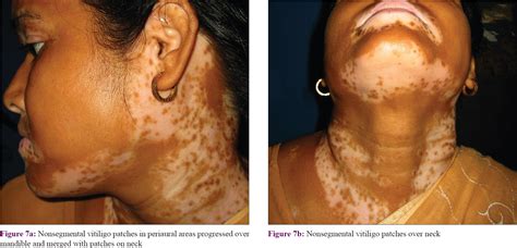 Nonsegmental vitiligo follows Blaschko's lines and embryonic pigmentary ...