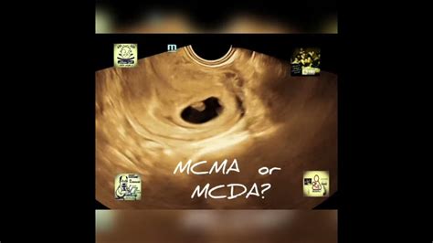 MCMA twins or MCDA twins - YouTube