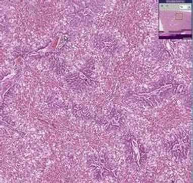 Histopathology Liver--Centrilobular necrosis from chloroform - YouTube