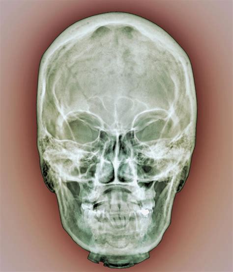 Normal Skull Photograph by Zephyr/science Photo Library - Fine Art America