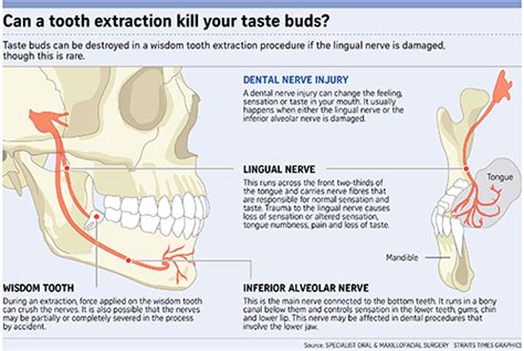 Inferior Alveolar Nerve Damage Wisdom Teeth - TeethWalls