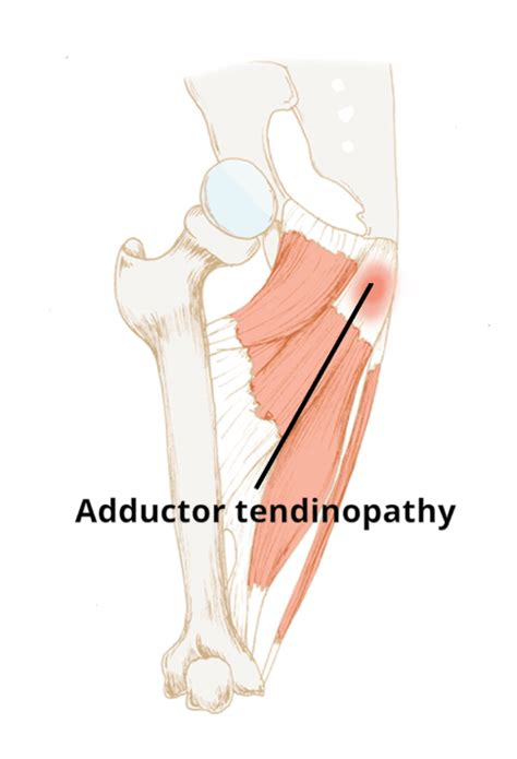 Groin Pain - How to Deal with Them - Elevate Physiotherapy