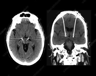 Parkinson's disease brain stimulation electrodes, CT scans - Stock Image - C040/3225 - Science ...