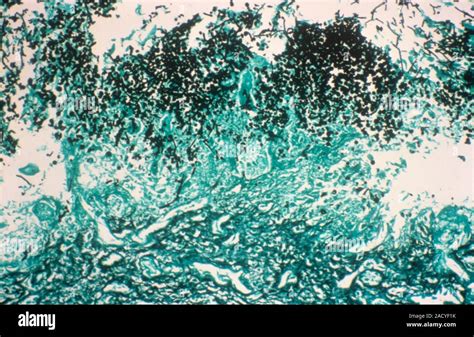 Oesophageal candidiasis. Light micrograph of a section through an oesophagus infected by Candida ...