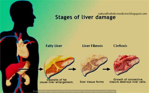 Treatment For Chronic Liver Disease - Cures For Chronic Liver Disease! - Natural Holistic ...