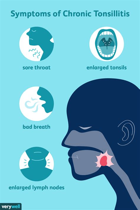 Chronic Tonsillitis: Causes and Symptoms