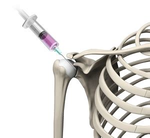 Intraarticular Shoulder Injection | Advanced Orthopaedics & Sports Medicine, Orthopaedic ...