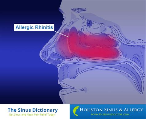 ClariFix® Cryotherapy for Chronic Rhinitis Relief