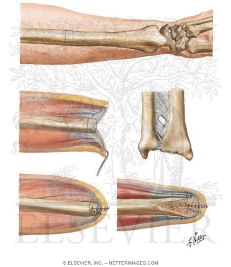 Amputation of the Forearm - Disarticulation Through the Wrist