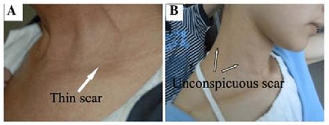 Inconspicuous thin neck scar of patients with cervical low incision at... | Download Scientific ...