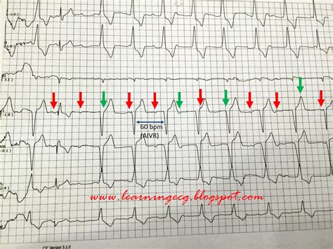 ECG Rhythms: Sinus rhythm, 2:1 AV block due to Mobitz II