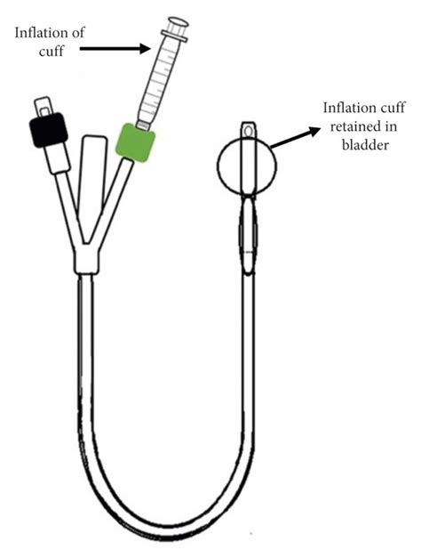 Urinary Catheter Types And Sizes And How To Choose, 55% OFF