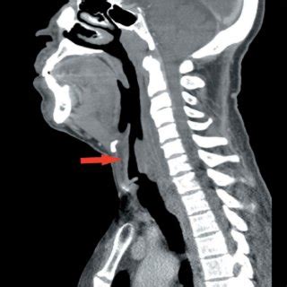 Axial contrast enhanced CT scan of neck soft tissue at the level of ...