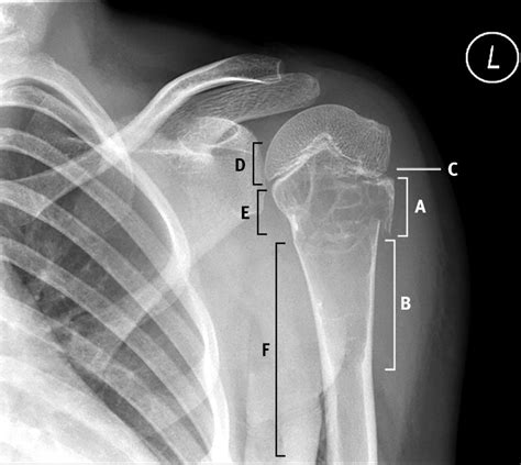 Xray Of The Humerus Fracture Of The Proximal Humeral