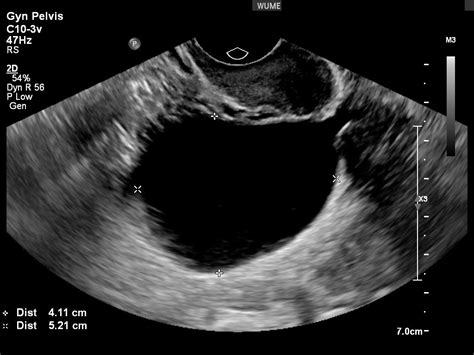 Gynaecology Ultrasound - Women's Ultrasound Melbourne