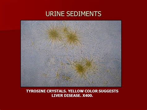 Bilirubin Crystal In Urine