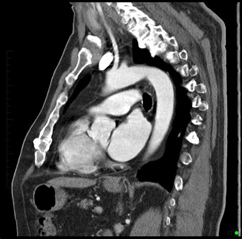 Chest CT Scan - Melbourne Radiology