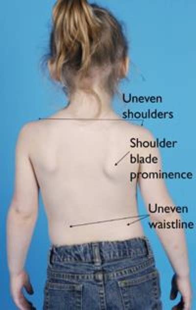 Congenital Scoliosis - OrthoInfo - AAOS