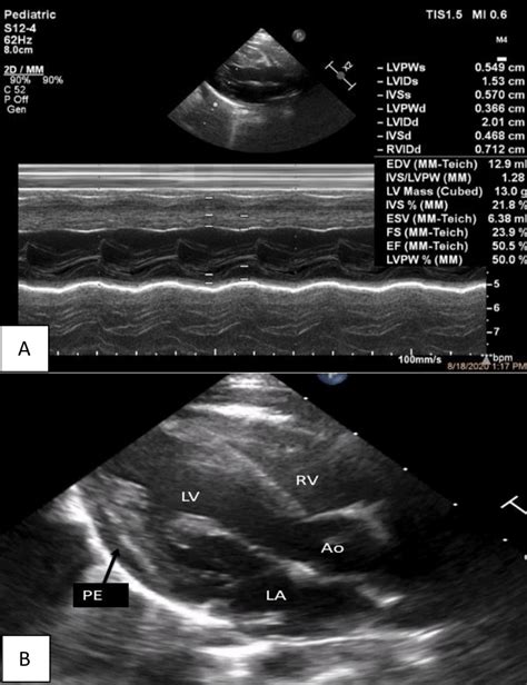 Echocardiography of case 3 (A) M-mode showing mild LV dysfunction. (B ...