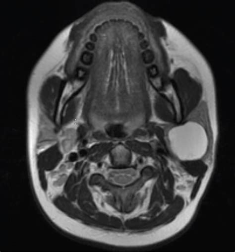 Type II First Branchial Cleft Cyst Presenting as Parotid Mass: A Case Report