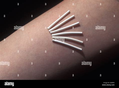 norplant hormone contraceptive implants Stock Photo - Alamy