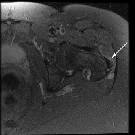 Hip Bursitis MRI