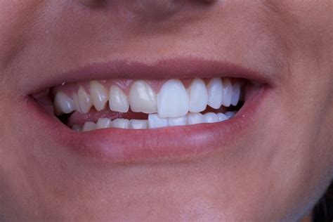 The Difference Between Veneers and Dental Bonding