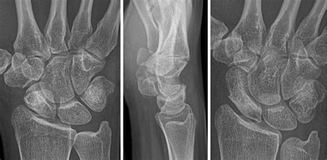 Scaphoid Fracture Avascular Necrosis