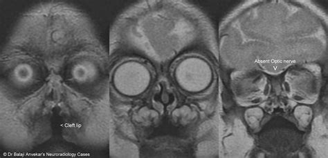 Dr Balaji Anvekar FRCR: Semi lobar holoprosencephaly MRI