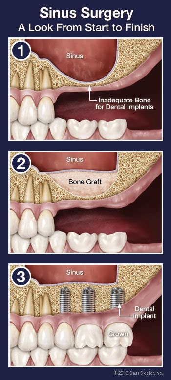 Sinus Surgery - Dentist Wyomissing, PA - Dental Education Library