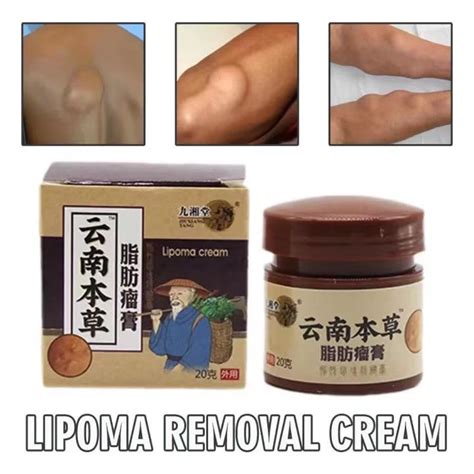 100% Natural Lipoma Removal Cream original Treat Tumor Skin Swelling ...