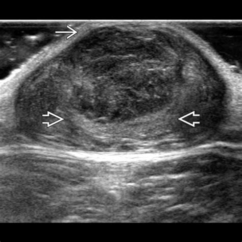 Epidermoid Cyst | Radiology Key