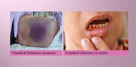 Vitamin K & Deficiency - New