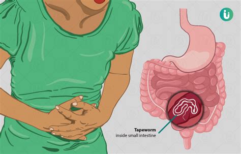 Tapeworm Infection symptoms, causes, treatment, medicine, prevention ...