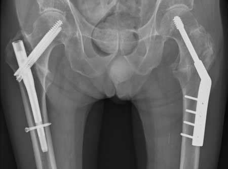 Registry data support sliding hip screws for simple two-part trochanteric fractures