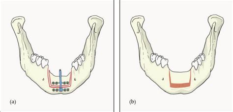 Distraction Osteogenesis procedure | News | Dentagama