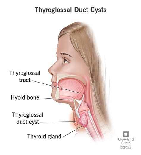 Thyroglossal Duct Cysts In Children Adults: Symptoms, 40% OFF