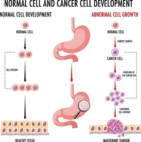 Diagram showing normal and cancer cells in human 6892353 Vector Art at ...