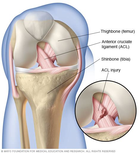 Anterior Cruciate Ligament Tear — Huang Orthopaedics