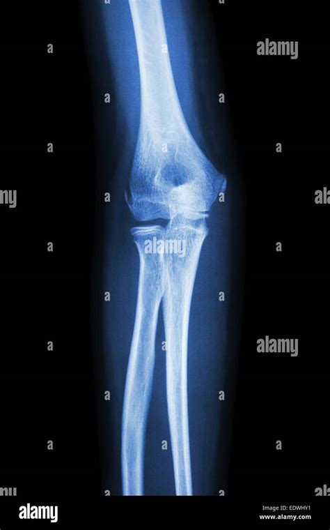 film x-ray elbow AP : show normal human's elbow Stock Photo - Alamy