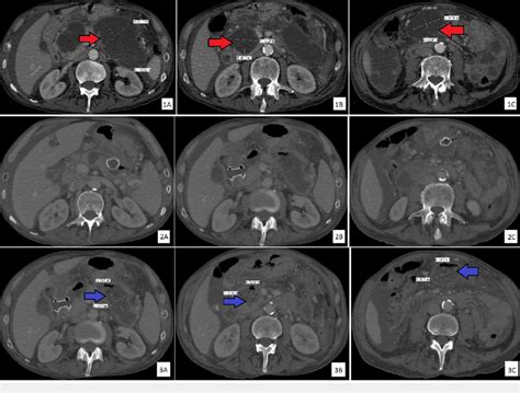 Computed tomography scans of the abdomen Computed tomography scans of... | Download Scientific ...