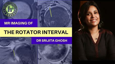 MRI SHOULDER | MRI OF ROTATOR INTERVAL | DR SRIJITA GHOSH | ANATOMY & PATHOLOGIES | BICEPS ...