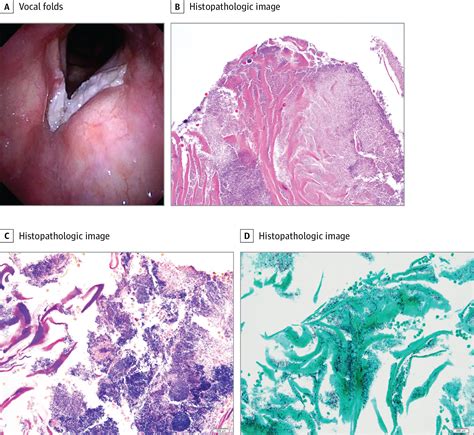 Laryngeal Disease